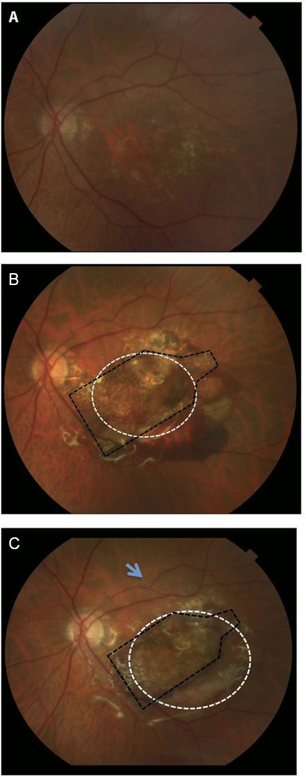 Vision loss